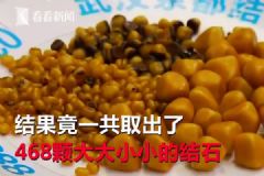 爱吃油炸长468颗结石，油炸食品的危害有哪些？[多图]