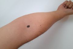 抠破黑痣，20岁小伙罹患恶性肿瘤险丧命[多图]