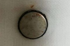 2岁男童误吞电池近20天却当胃病医，取出已严重腐蚀[多图]