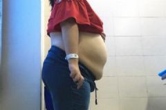 女学生肚子内藏巨大包块，囊液相当于24瓶矿泉水[多图]