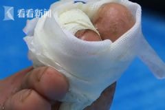 女子被毒虫叮咬不以为意，谁知脚趾溃烂险些截趾[多图]