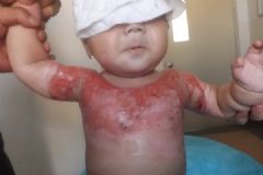 3岁男童被开水烫伤，外婆凭经验伤口撒盐加重伤势[多图]