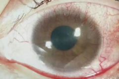 女子高中时开始戴美瞳，十年下来两眼的角膜严重缺氧[多图]