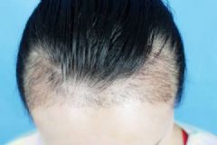 为什么发际线越来越高？发际线高该怎么办？[多图]