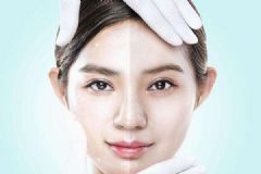 光子治疗后色斑变深了怎么回事？光子治疗要注意些什么？[多图]