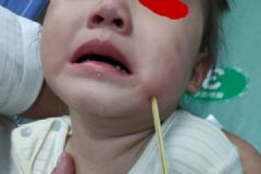 深圳2岁幼儿吃热狗不慎跌倒，竹签插进面部达7厘米[多图]