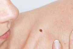 除黑痣的方法有哪些？黑痣都有哪些种类？[多图]