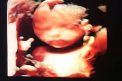 欧弟晒妻子二胎B超照，曝二胎是女儿！[多图]