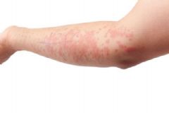 皮肤过敏该如何预防？皮肤过敏有何危害？[图]